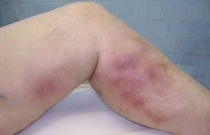 Thrombophlébite avec varices chez la femme