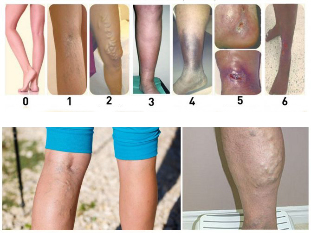 classification des varices