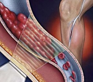 La thrombose veineuse profonde