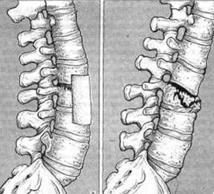 Les blessures dans les lombaires