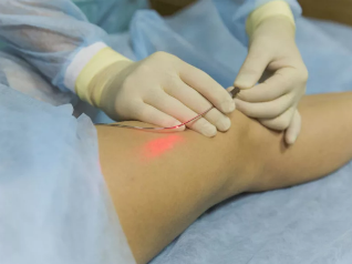 Traitement des varices par laser