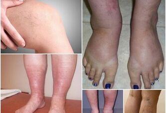Photo de démonstrations de varices sur les jambes