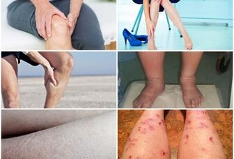 Symptômes de varices sur les jambes