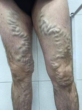 Les varices masculines négligées