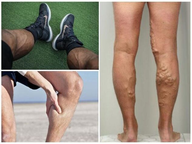 comment les varices apparaissent sur les jambes des hommes