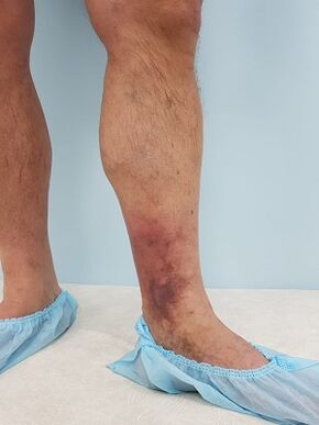 complications des varices chez les hommes