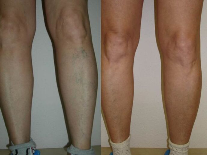 jambes avant et après le traitement au laser des varices