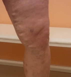 varices