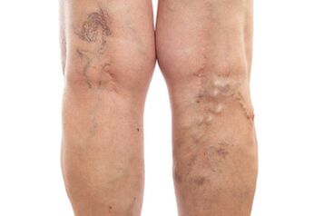 varices des membres inférieurs